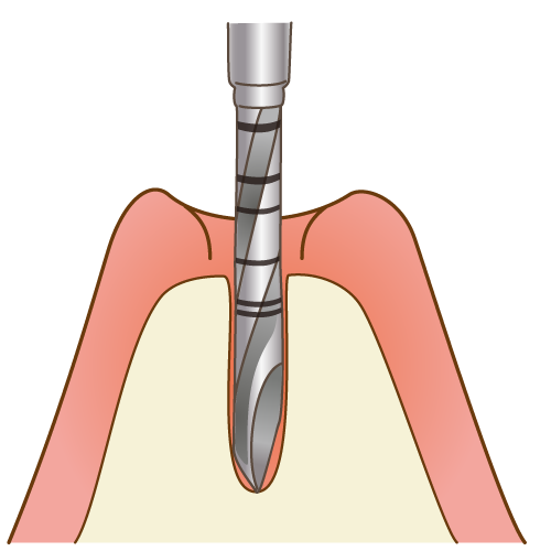 インプラントの埋入