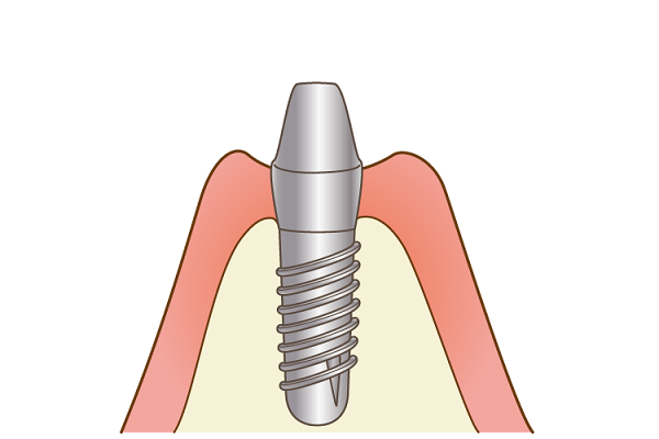 インプラント埋入2