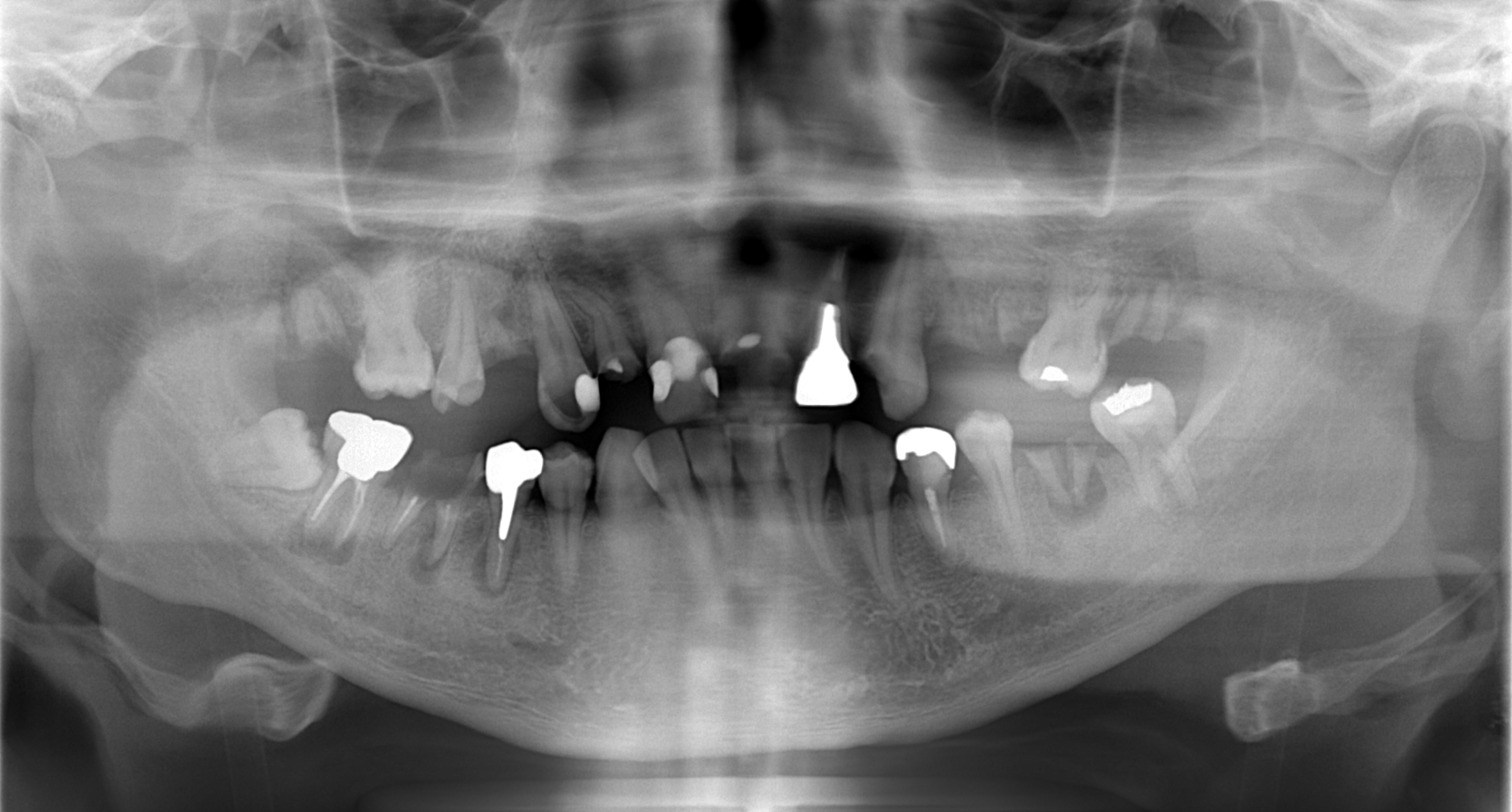 歯がボロボロになってしまった治療前1(神戸三宮谷歯科クリニック)