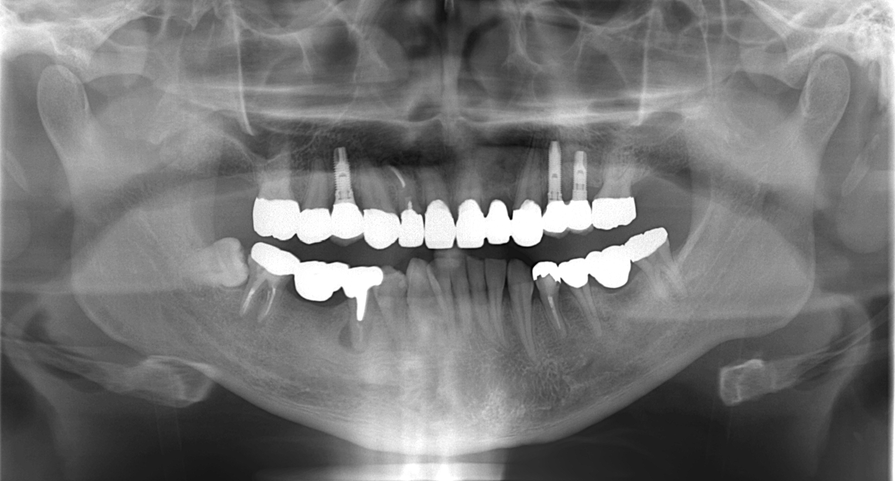 歯がボロボロになってしまった治療後2(神戸三宮谷歯科クリニック)